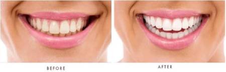 denta-vive-before-after-smile-teeth-healthy